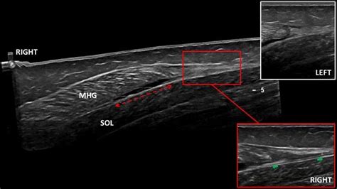 test for calf tear|torn calf muscle ultrasound.